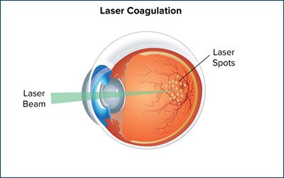 Diabetic_laser_treatment