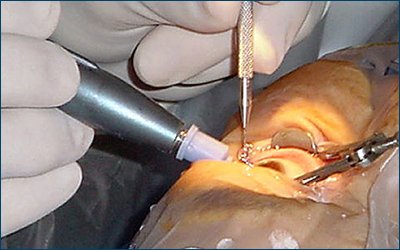 Phacoemulsification_surgery